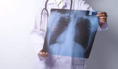 Akciğer kanserinin 5 erken belirtisi