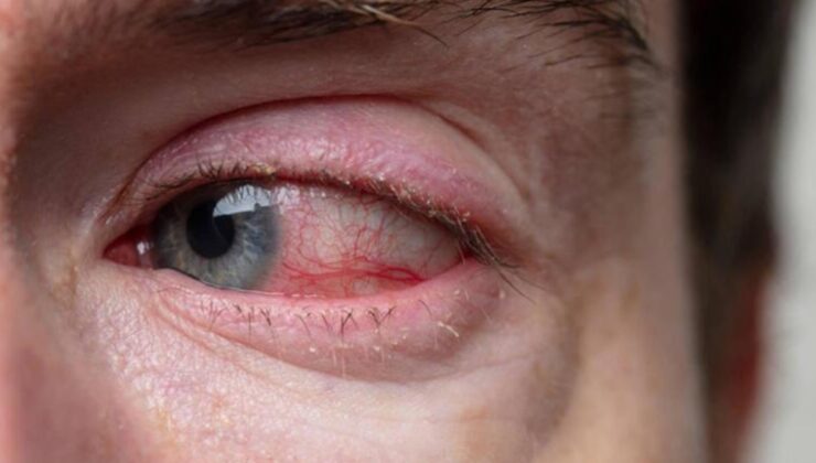 Kaşıntı, yanma, kızarıklık! Gözlerde ‘adenovirüs’ semptomları….