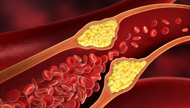Türk doktordan damar tıkanıklığını gidermede yeni yöntem